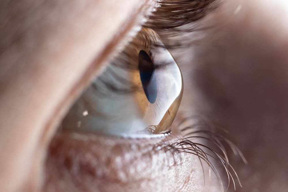 Closeup of an Eye With Keratoconus